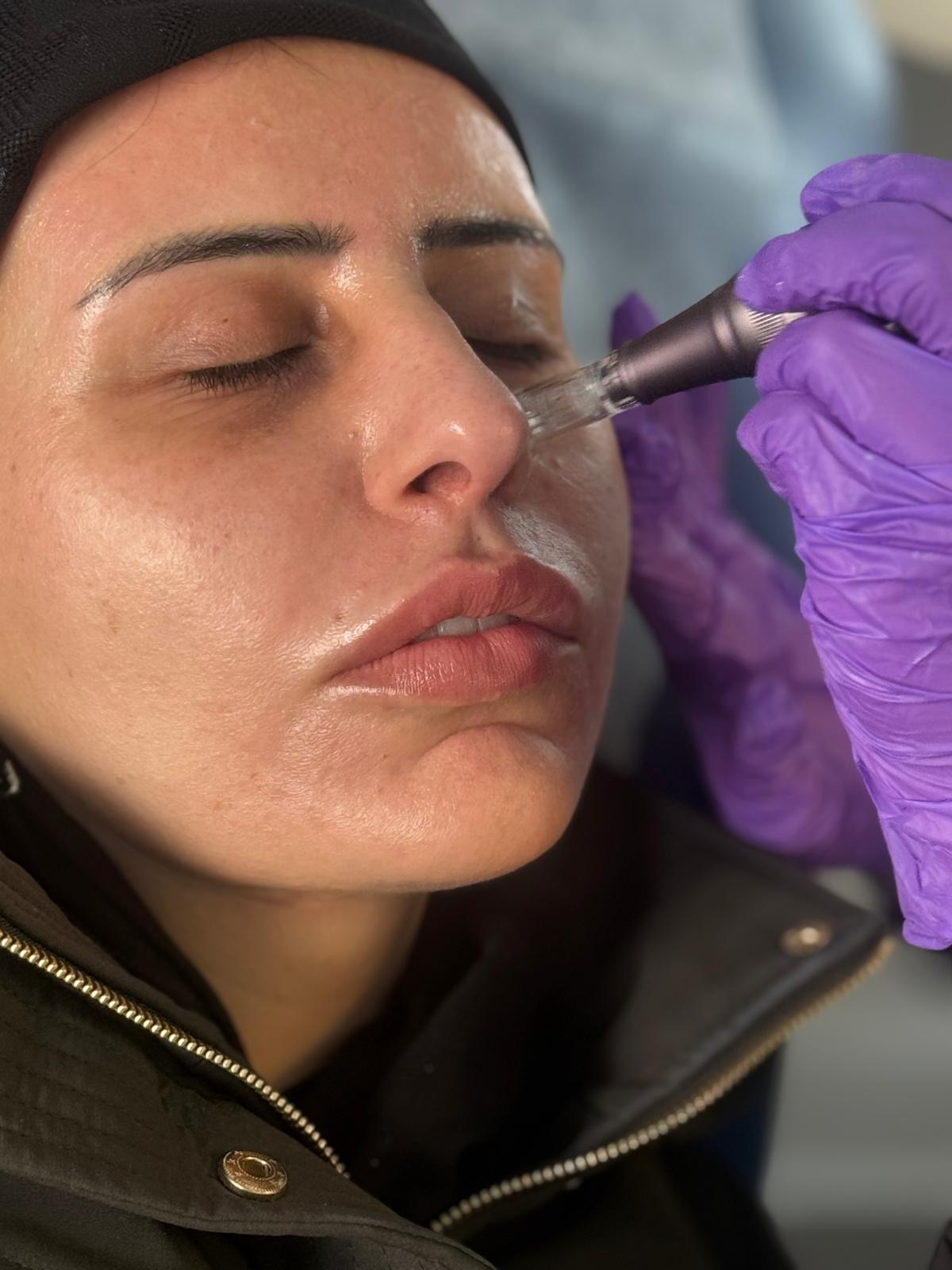 Microneedling Treatment
