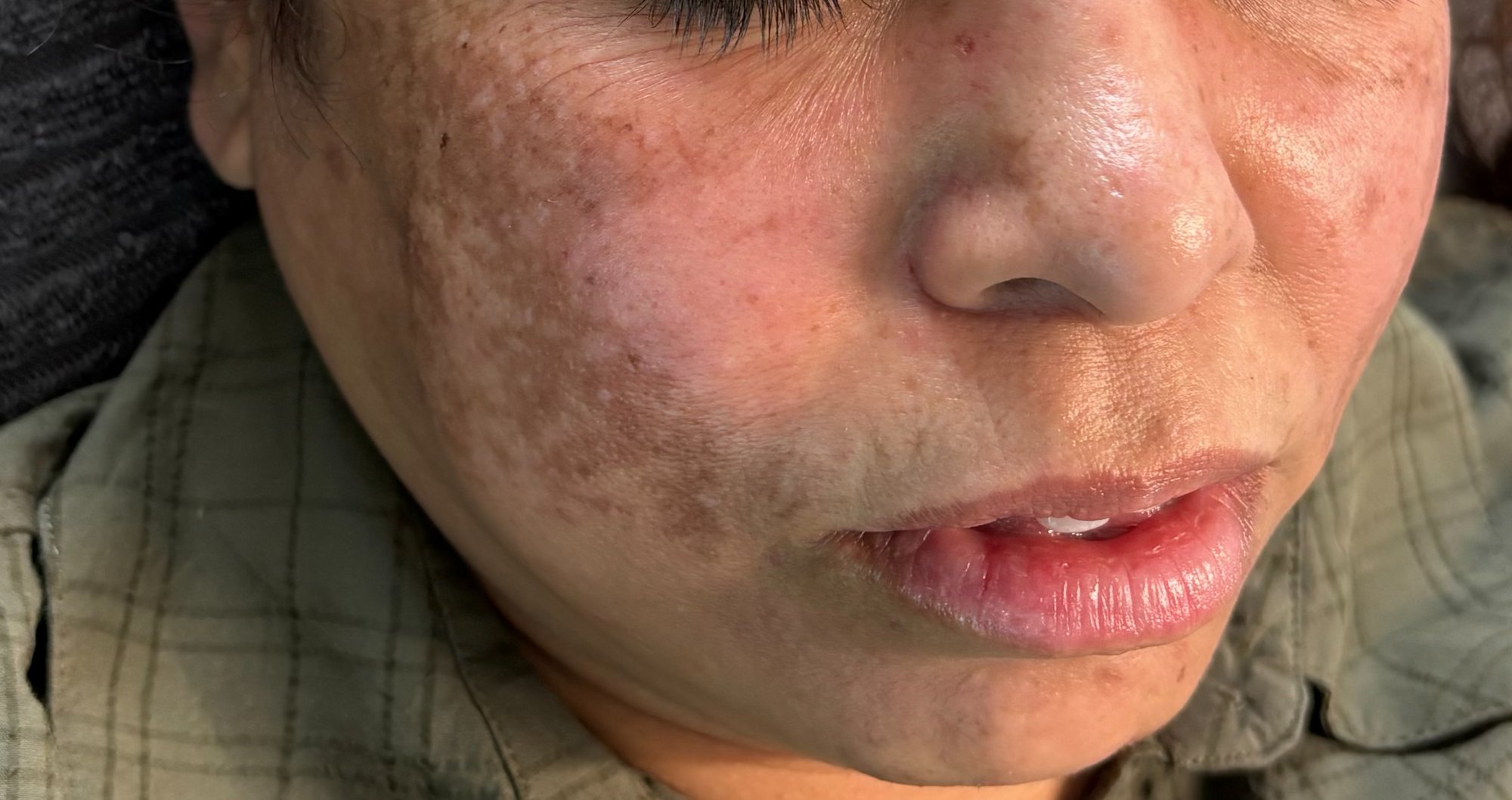 Pigmentation Treatment